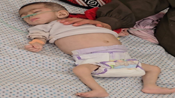 مأساة في غزة: طفلة شهيدة بسبب الجوع